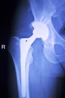 Stryker Hip Implant Recall - McGartland Law Firm